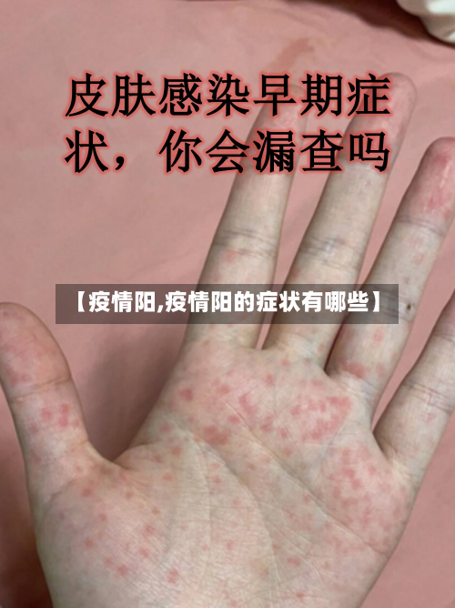 【疫情阳,疫情阳的症状有哪些】