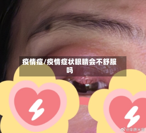 疫情症/疫情症状眼睛会不舒服吗-第2张图片